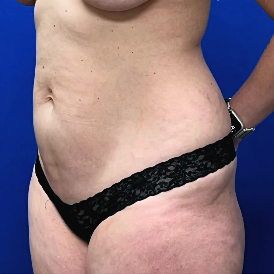 Before Mommy Makeover — abdominal view showing laxity and flank fullness