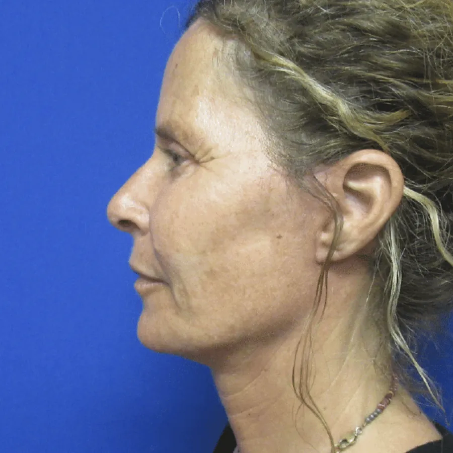 Three months after lower facelift with Dr. Brian Cripe — profile view showing restored jawline and neck contour
