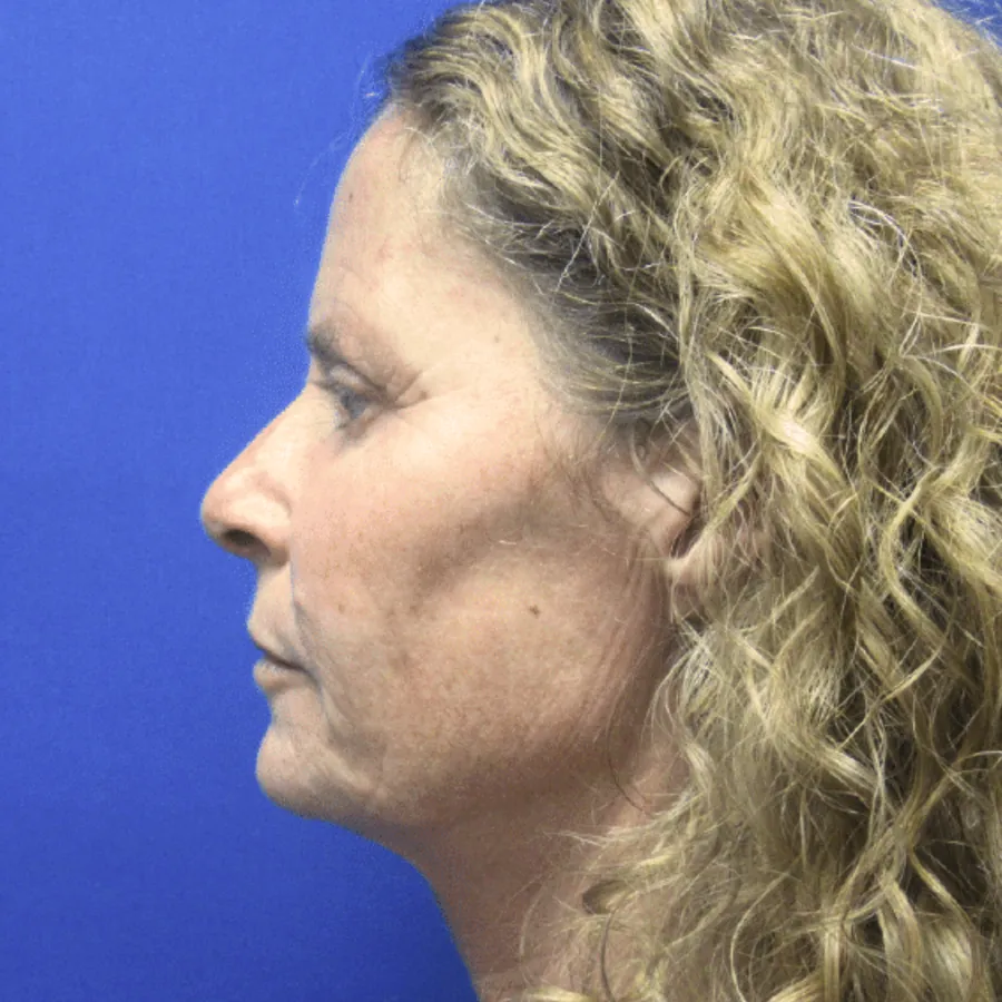 Before lower facelift — profile view showing jowling and neck laxity