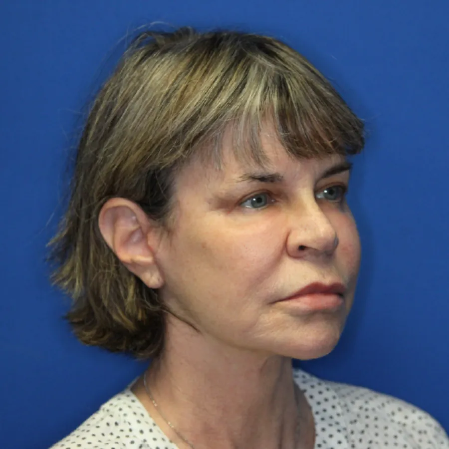 Three months after Comprehensive Facial Rejuvenation with Dr. Brian Cripe &mdash; oblique view showing restored jawline and neck contour