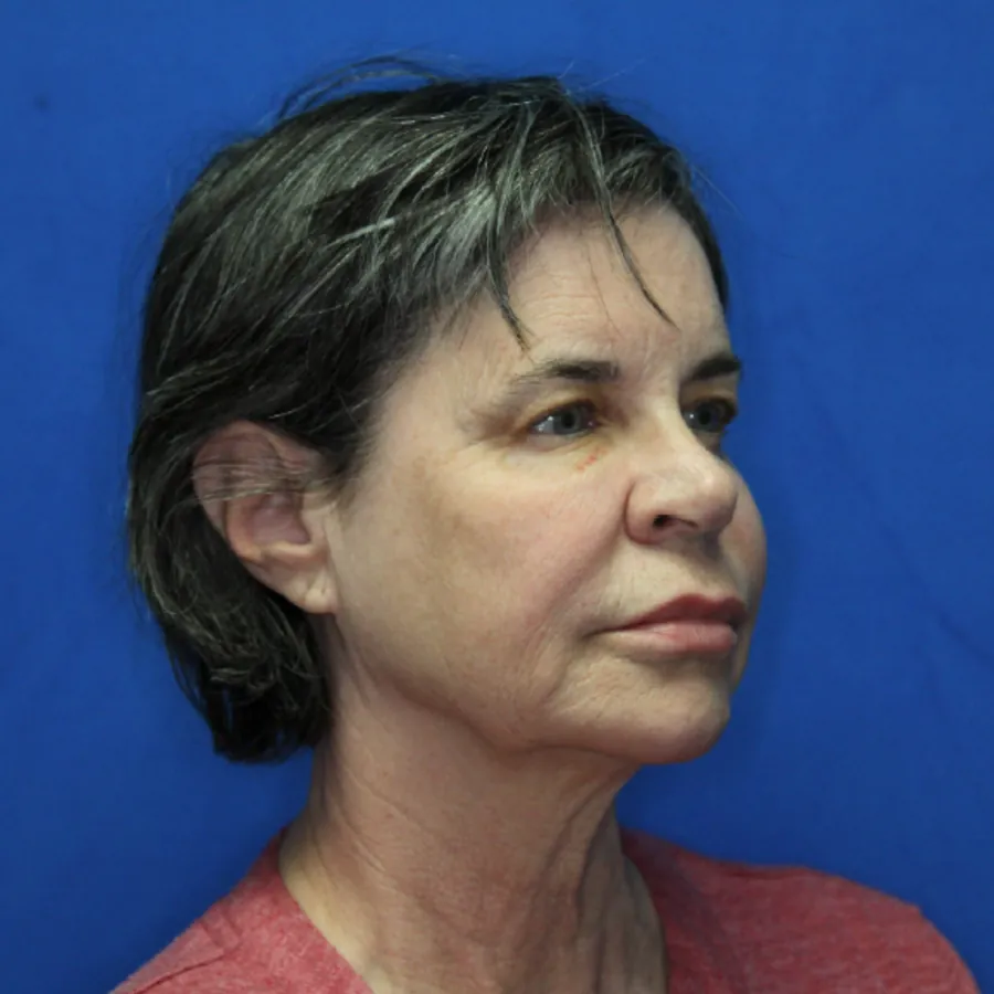 Before Comprehensive Facial Rejuvenation &mdash; oblique view showing jowling and neck laxity